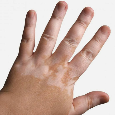 O que é vitiligo? Entenda a doença e como ela surge 