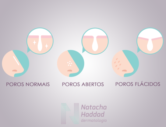 Poros dilatados abertos - Dra. Natacha Haddad - Dermatologista
